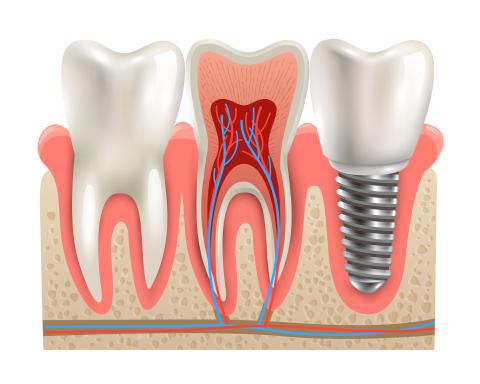 implantant